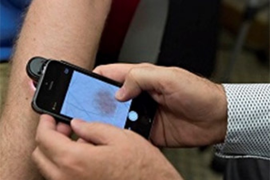 iPhone-ով հնարավոր է բացահայտել մաշկի քաղցկեղը