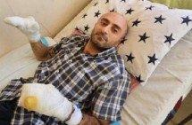 Есаи Карамян, которому в результате применения светозвуковой гранаты ампутировали запястье, будет прооперирован во второй раз: Его наконец признали потерпевшим